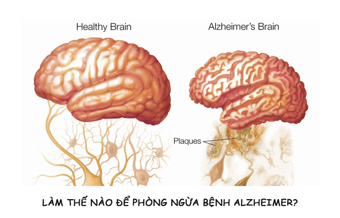 Làm thế nào để phòng ngừa bệnh Alzheimer?